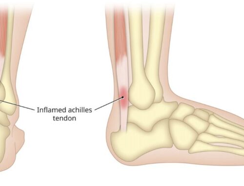 ACHILLES TENDINOPATHY